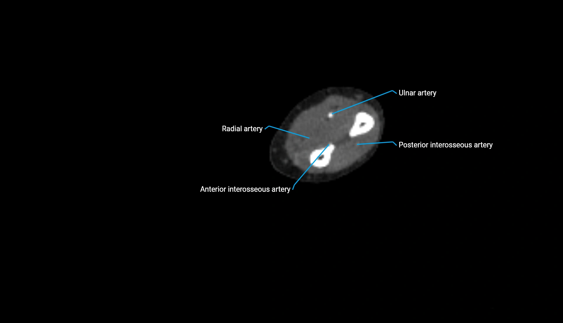 CTA upper limb axial cross sectional anatomy labelled image 140 (2).webp